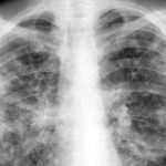 Найден новый метод лечения смертоносного штамма туберкулеза