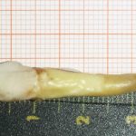 Как выглядит самый длинный человеческий зуб в мире