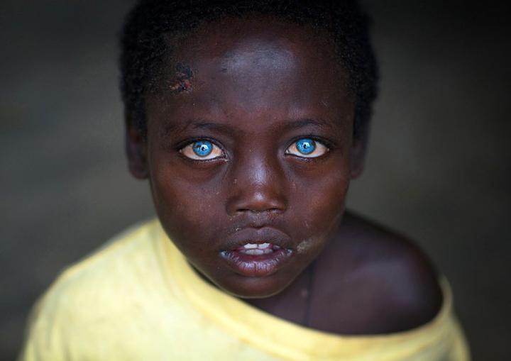 Эфиопский мальчик Абуше с синдромом Ваарденбурга. Фото: ericlafforgue.com